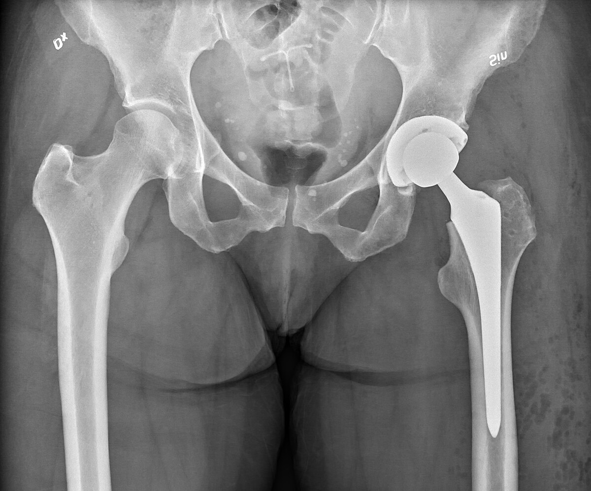 Hip Replacement Surgery Procedure