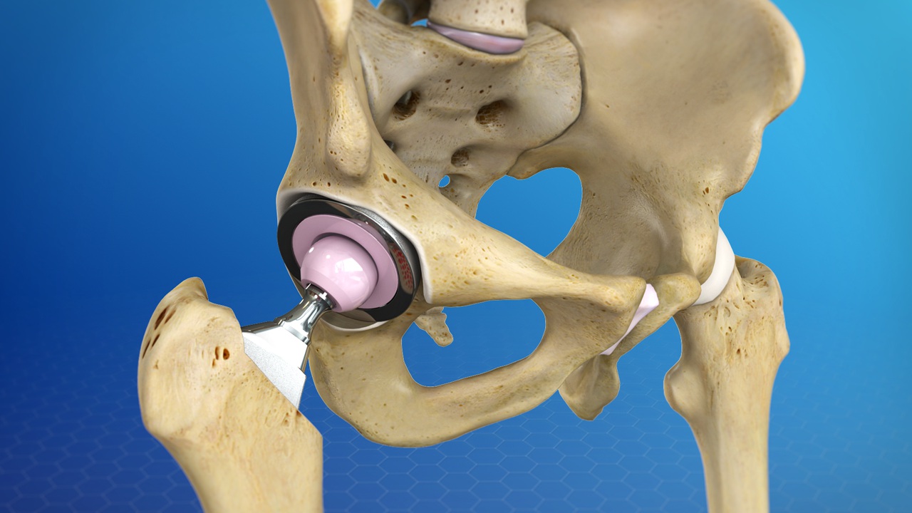 Hip Replacement Surgery Procedure