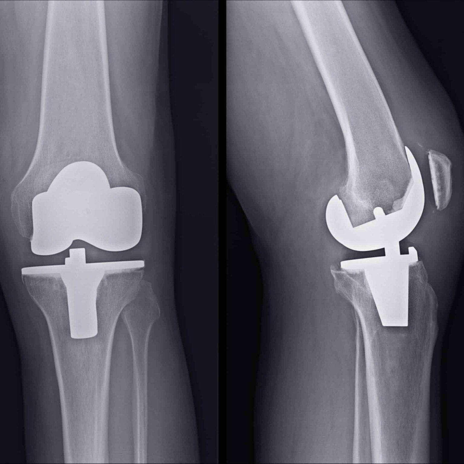 Knee Replacement Surgery Procedure