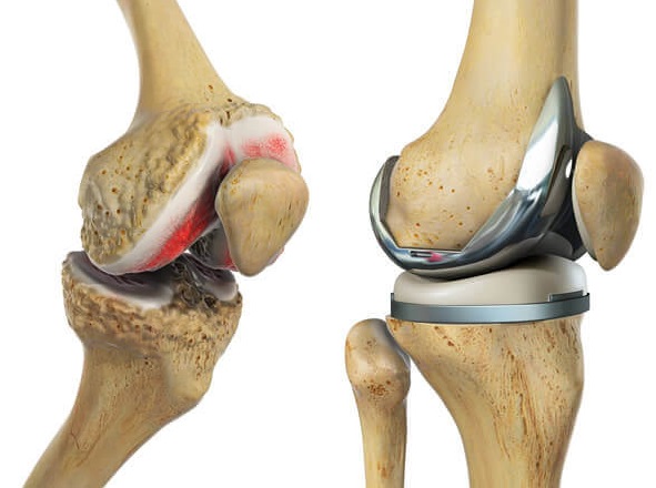Knee Replacement Surgery Procedure