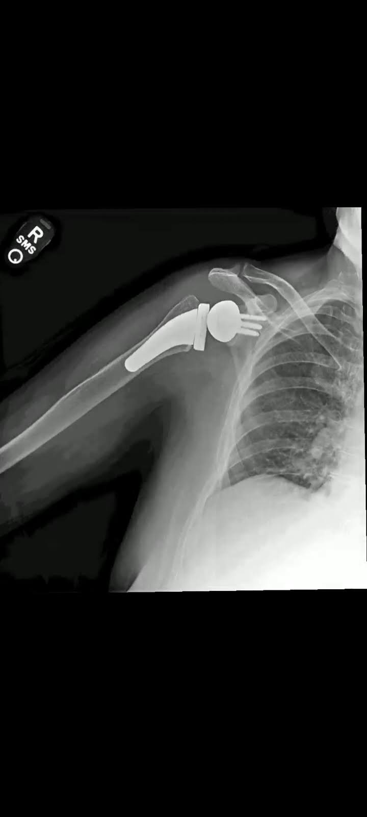 Shoulder Replacement Surgery Procedure
