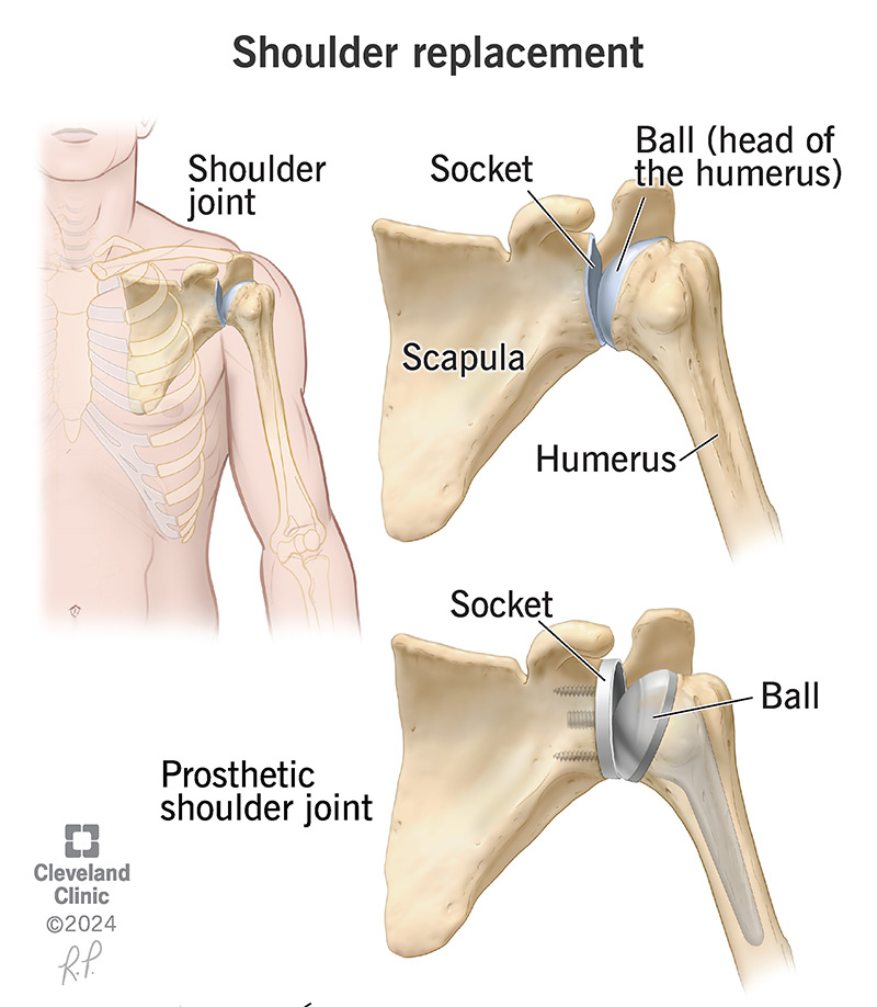 Shoulder Replacement Surgery Procedure