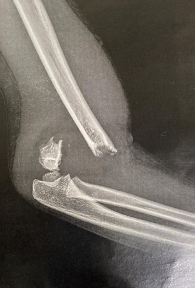 Elbow Fracture