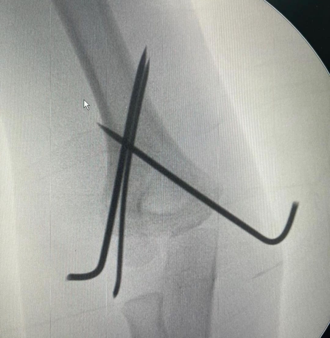 Elbow Fracture