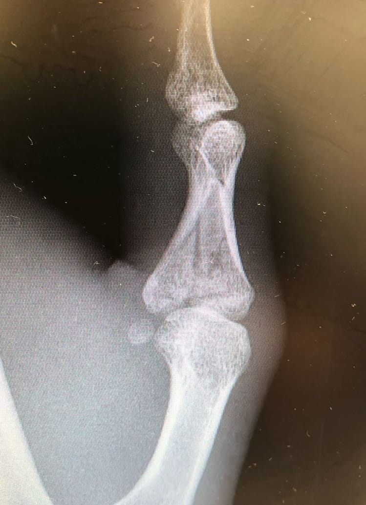 Finger fracture fixation