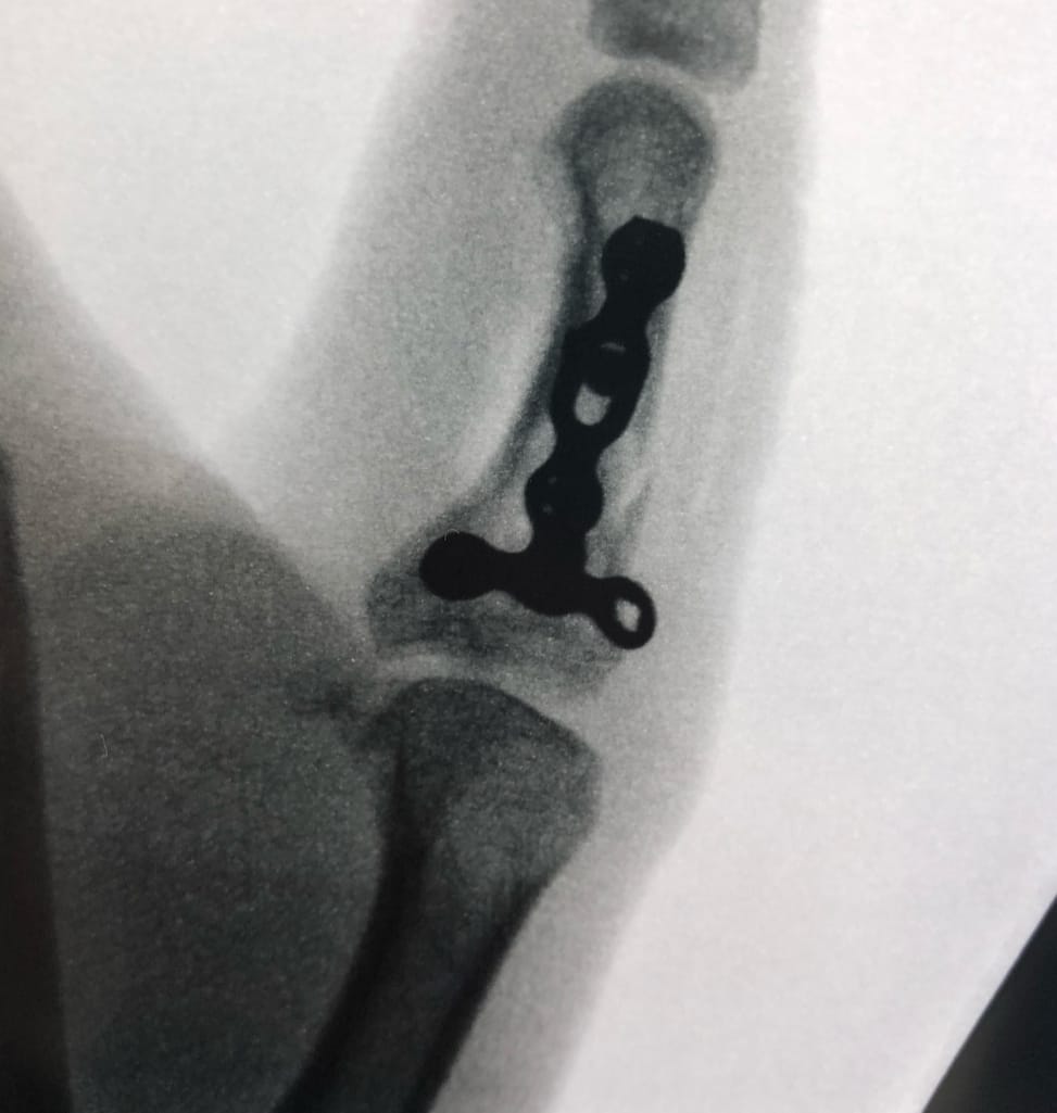 Finger fracture fixation